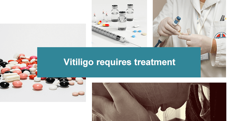 Vitiligo requires treatment
