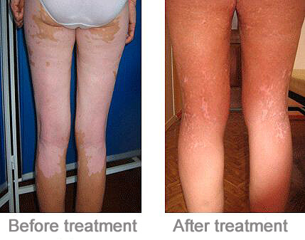 uv lamp vitiligo treatment