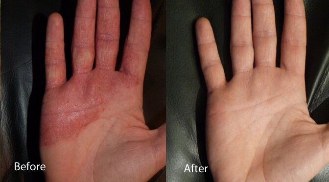 uv light therapy for hand eczema