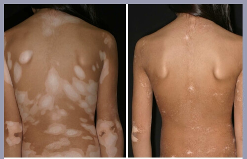 Vitiligo uvb treatment before and after