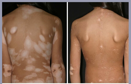 vitiligo light therapy at home