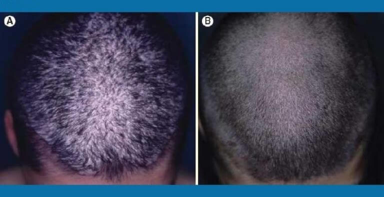 ultraviolet and inverse psoriasis Inverse psoriasis — this type of psoriasis affects less visible body areas ultraviolet light — exposure to ultraviolet light is another way to treat psoriasis. ultraviolet and inverse psoriasis Inverse psoriasis — this type of psoriasis affects less visible body areas ultraviolet light — exposure to ultraviolet light is another way to treat psoriasis.