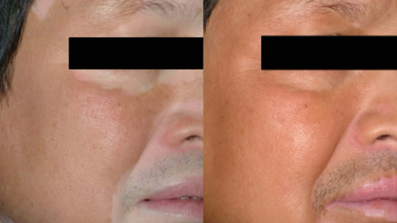 light treatment for vitiligo