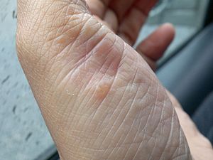 Pustular psoriasis