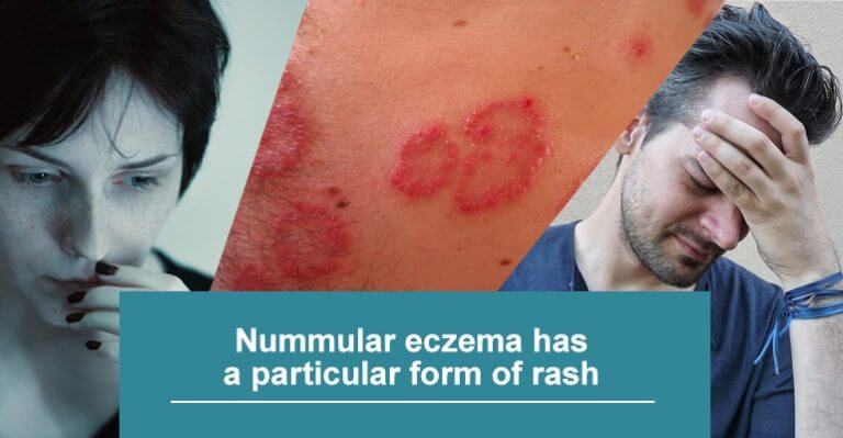 Nummular Eczema: Causes and Effective Treatment | UVB – Lamps