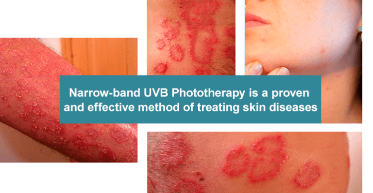 The Healing Light: Narrow-band UVB Phototherapy | UVB – Lamps